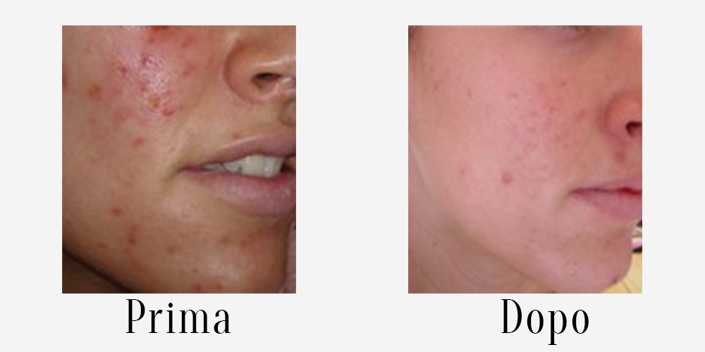 3 before-after-acne2.png