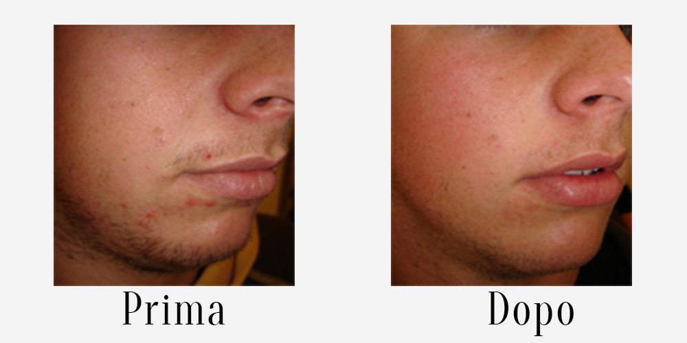 3 before-after-acne5.png
